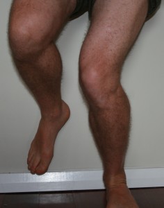 Knee pain and valgus collapse