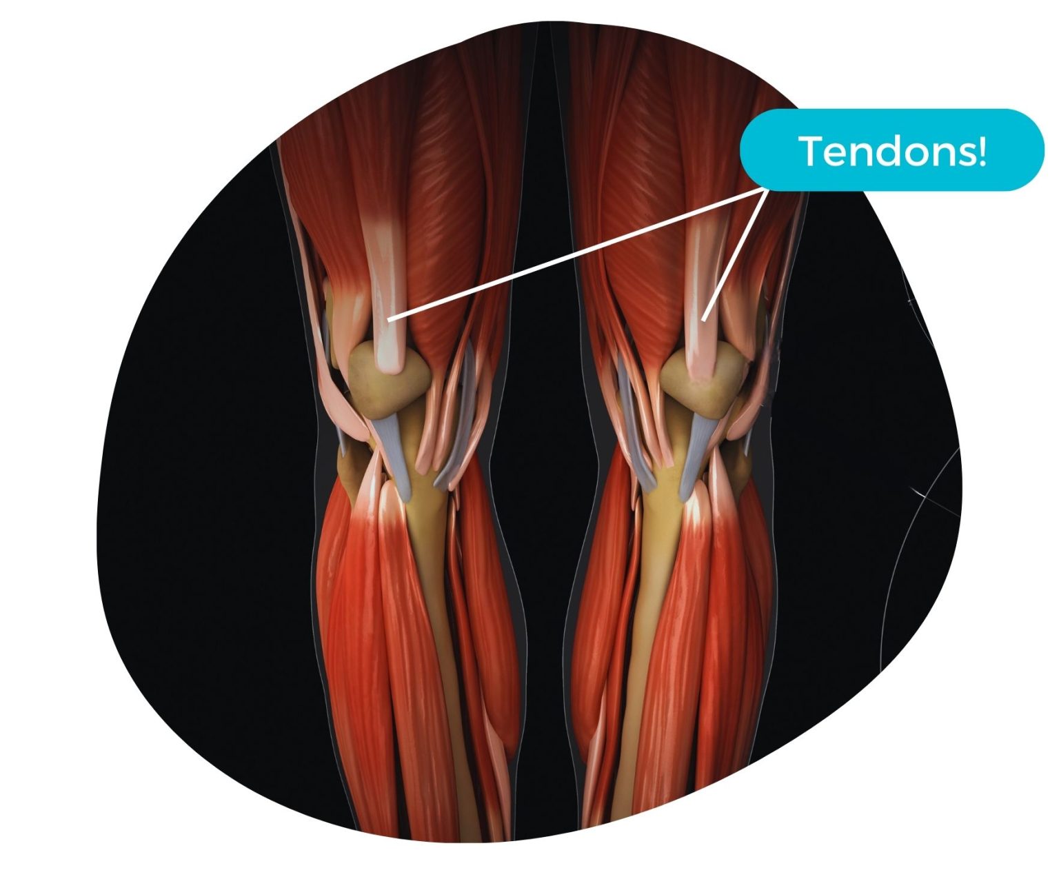 Lets Talk Tendinopathy | Newcastle Physiotherapy